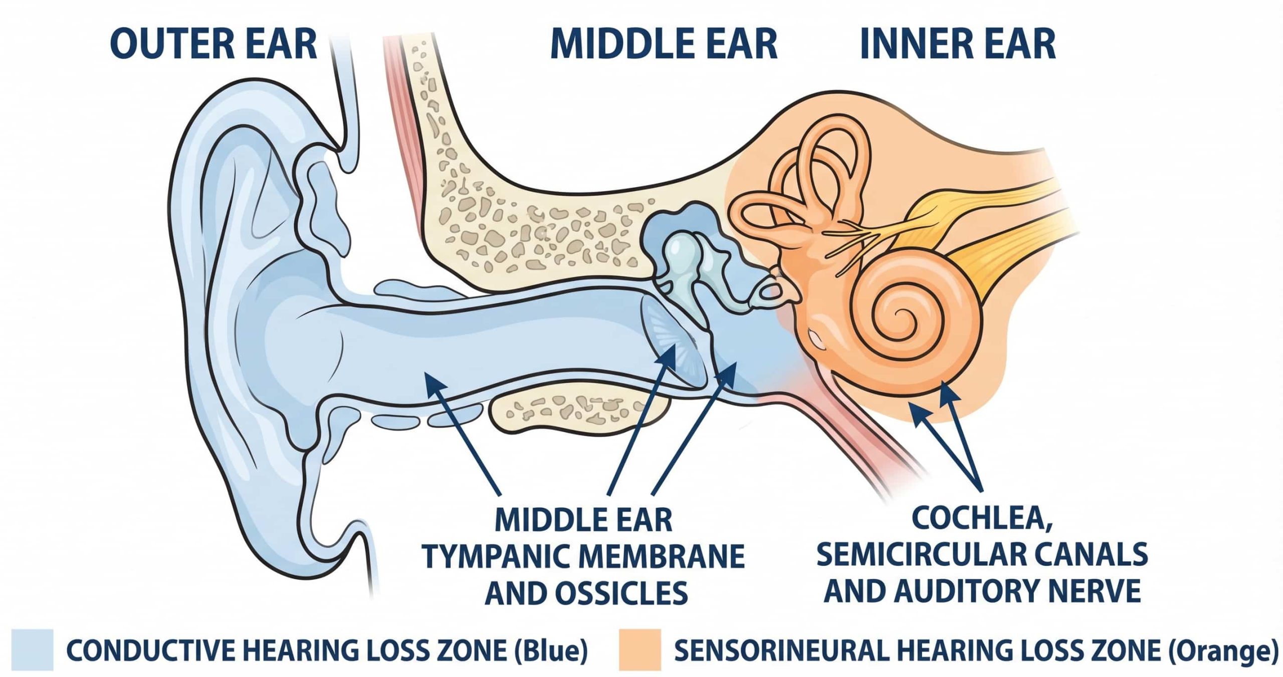 Types of Hearing Loss Explained: Sensorineural, Conductive and Mixed